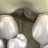 ボーンキャビティ（Bone Cavity）