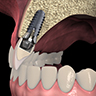 骨がない、薄い場合のインプラント治療