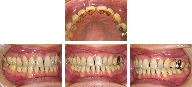 初診時（前歯すきっ歯）