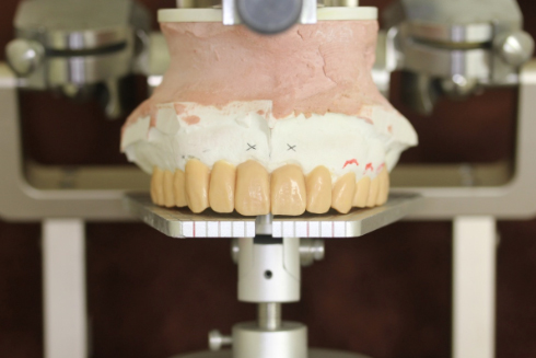 Occlusal reconstruction