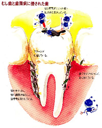 歯周病とは