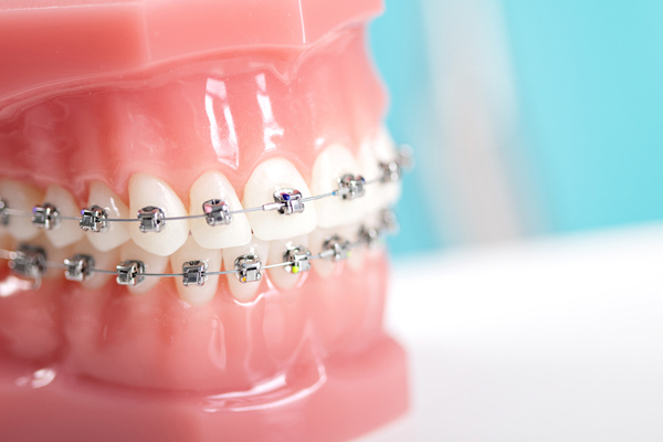 歯列矯正歯科治療