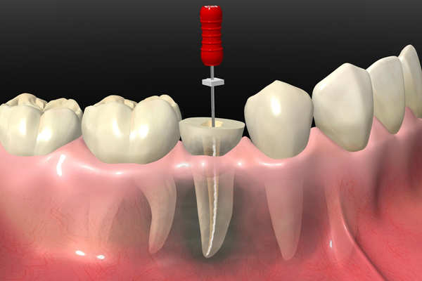 根管治療・歯内療法を理解する